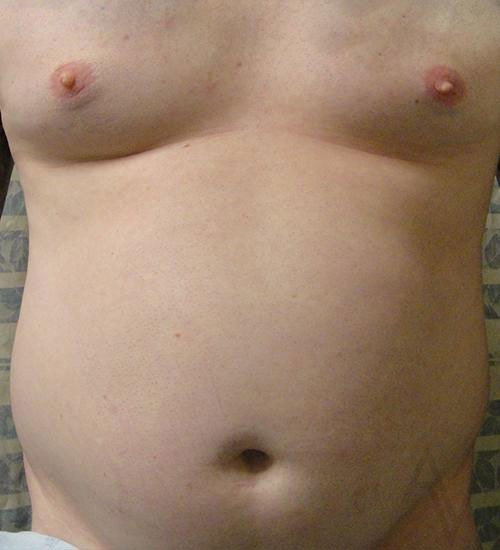Male Liposuction in Toronto