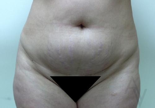 Liposuction Vs. Tummy Tuck In Toronto