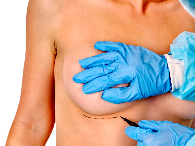 Breast Augmentation – Toronto Plastic Surgery