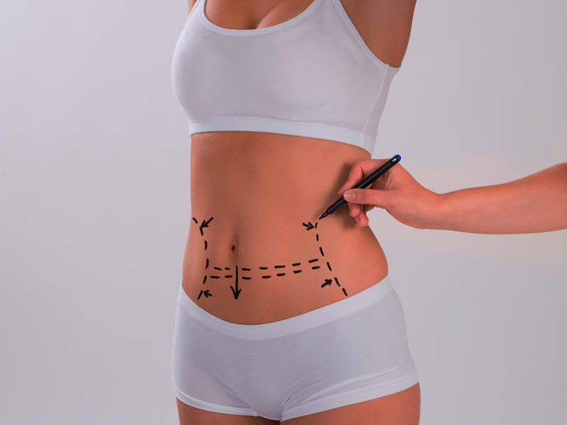 Should You Lose Weight Before A Toronto Tummy Tuck Surgery?