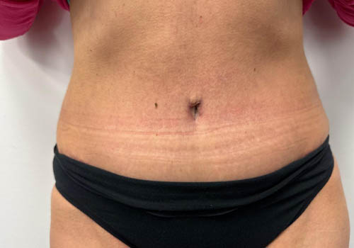 Tummy Tuck