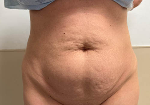 Tummy Tuck