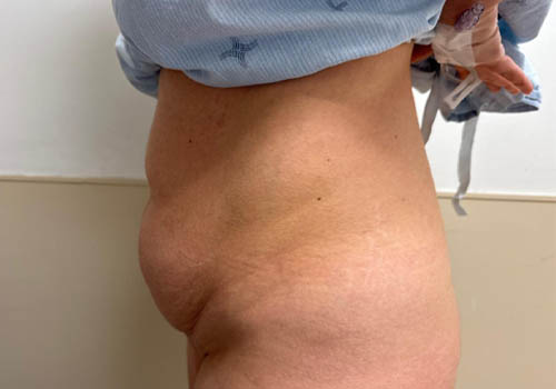 Tummy Tuck