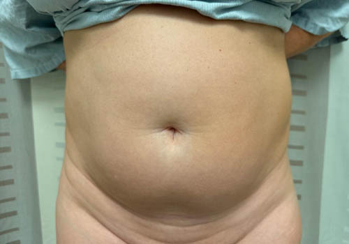 Liposuction