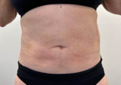 Liposuction