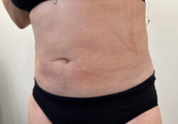 Liposuction