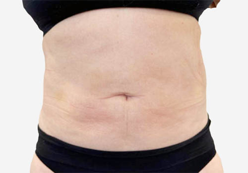 Liposuction Surgery in Toronto before and after photos Liposuction Surgery in Toronto before and after photos