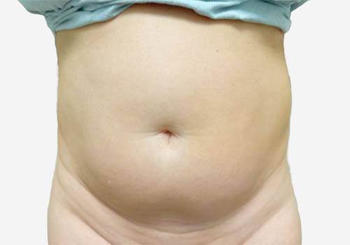 Liposuction Surgery in Toronto before and after photos Liposuction Surgery in Toronto before and after photos