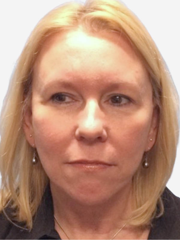 Neck Lift Before and after photos in Toronto by Dr. Golger Neck Lift Before and after photos in Toronto by Dr. Golger