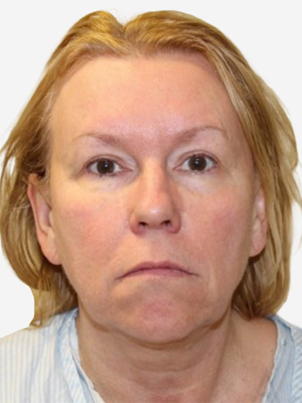 Neck Lift Before and after photos in Toronto by Dr. Golger Neck Lift Before and after photos in Toronto by Dr. Golger