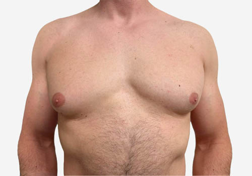 male breast reduction before and after photos by Toronto plastic surgeon Dr. Golger male breast reduction before and after photos by Toronto plastic surgeon Dr. Golger