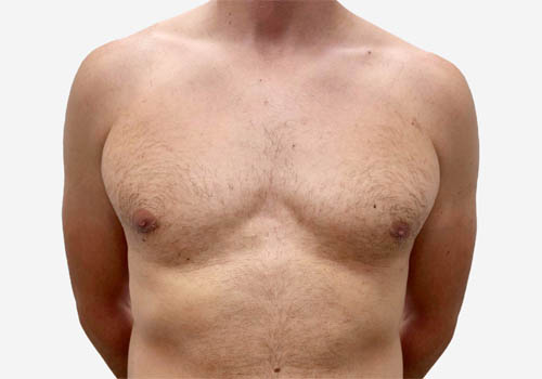 male breast reduction before and after photos by Toronto plastic surgeon Dr. Golger male breast reduction before and after photos by Toronto plastic surgeon Dr. Golger